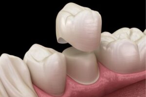 Implantes-Dentales-con-Coronas-de-Porcelana