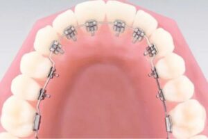 brackets linguales precio perú