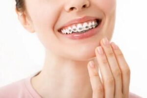 brackets metálicos precio perú