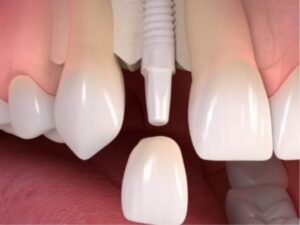 implante dental de zicronio