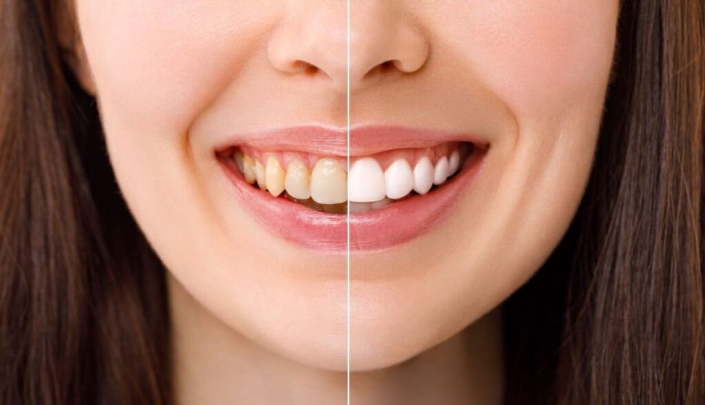 blanqueamiento dental precio