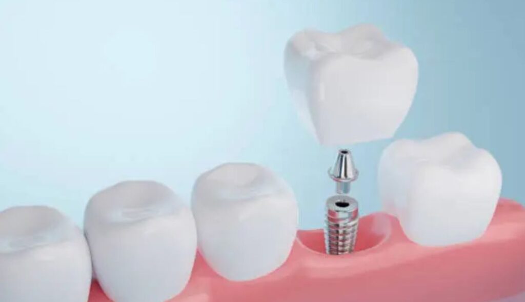 implantes dentales precios
