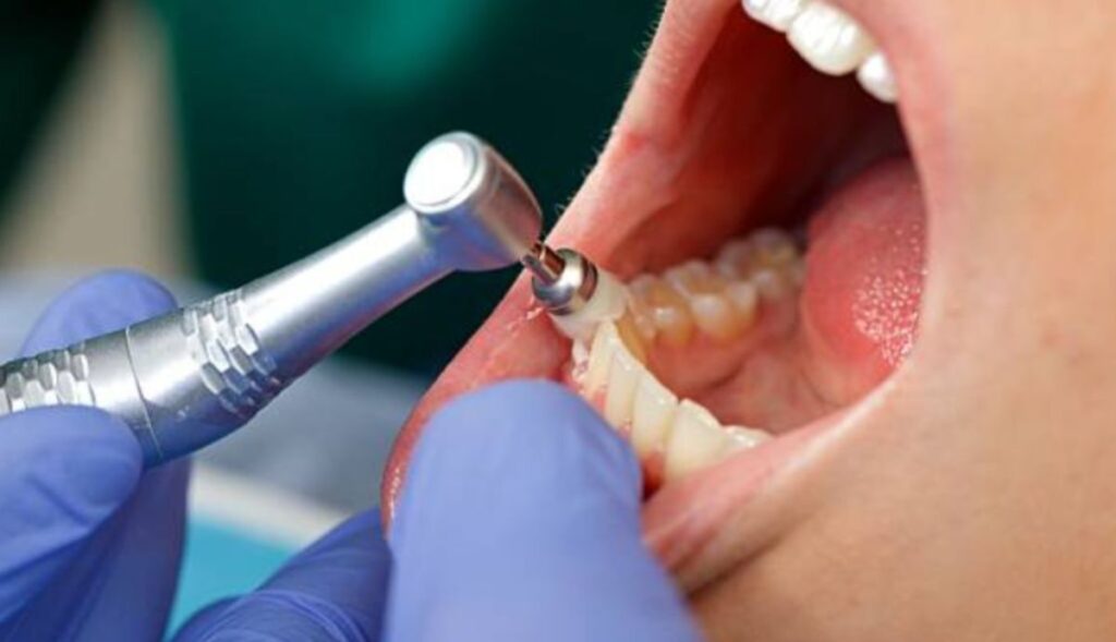 limpieza dental precio