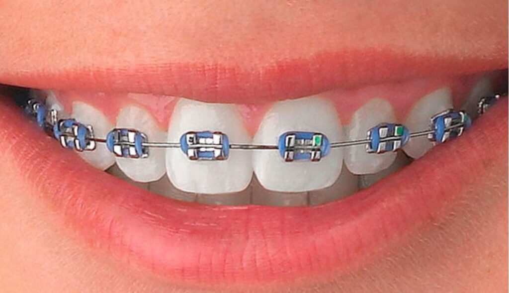 brackets precio