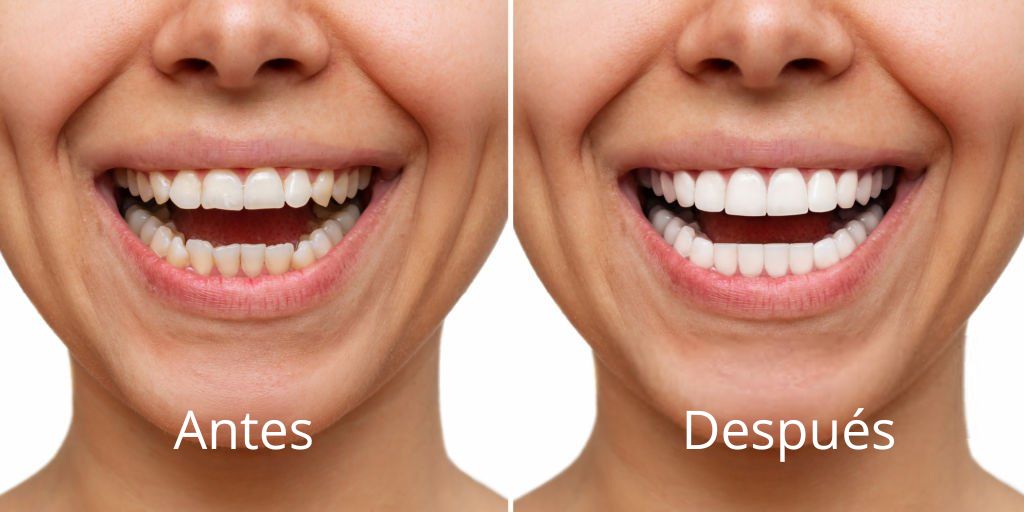 carillas dentales antes y despues