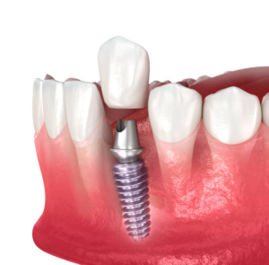 que es un implante dental